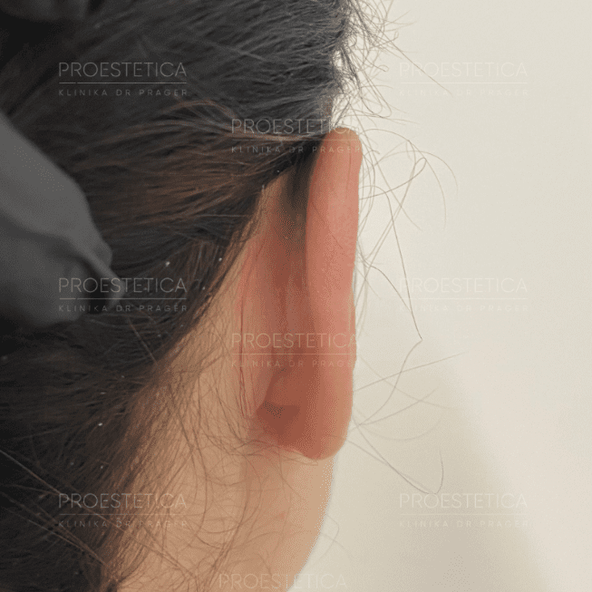 Zdjęcie wygojonej małżowiny usznej - 15 dni od zabiegu