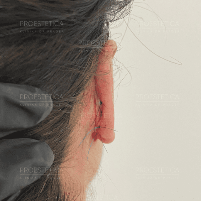 Zdjęcie bezpośrednio po korekcie tylnej małżowiny usznej - Klinika Medycyny Estetycznej - Proestetica