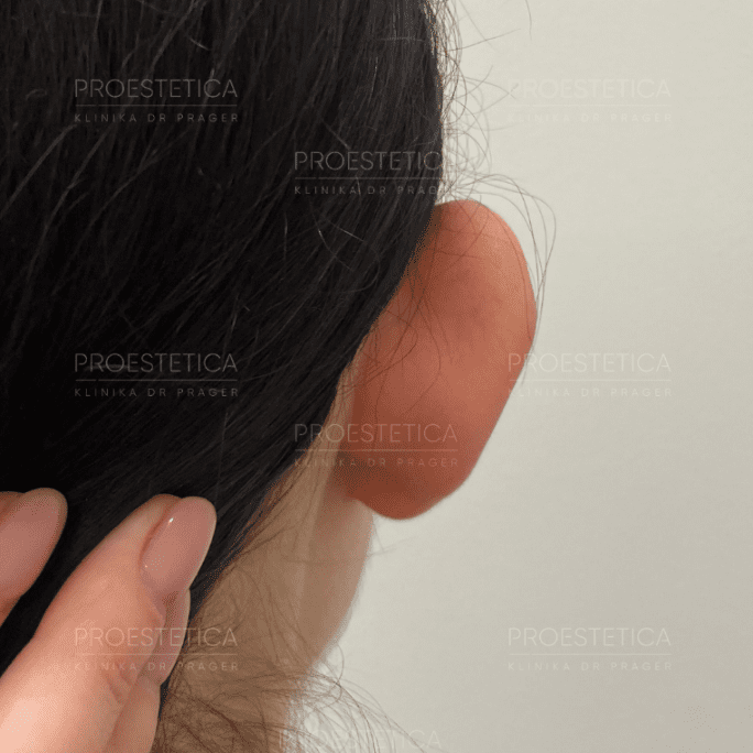 Zdjęcie małżowiny usznej tylnej przed zabiegiem - Klinika Medycyny Estetycznej Proestetica