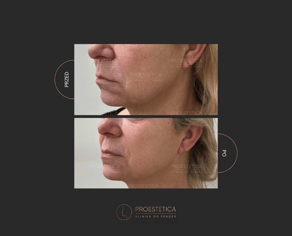 Laserowy zabieg wolumetryczny. Poprawa owalu twarzy.