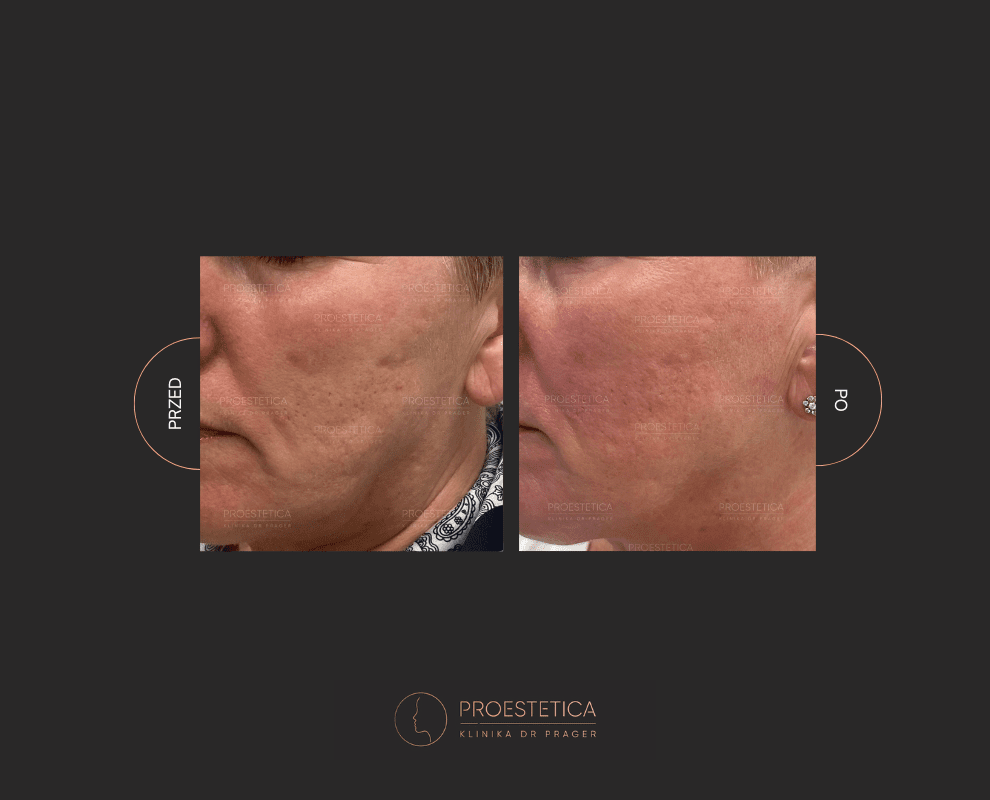 Przebudowa i zagęszczenie skóry przy użyciu radiofrekwencjii mikroigłowej. Efekty zabiegu.